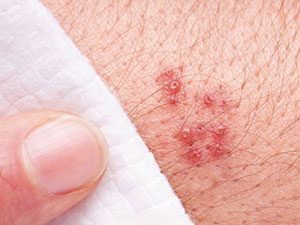 9. Turpentine Cures Shingles
