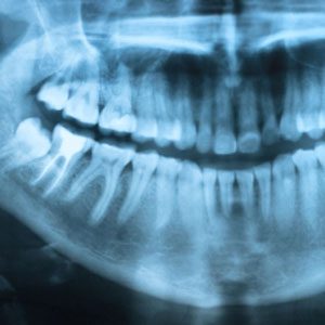 What is a Root Canal?