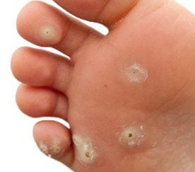 What Are the Causes of Warts?