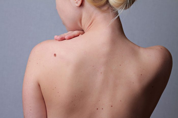 Woman with moles
