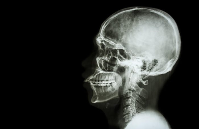 X-ray of skull