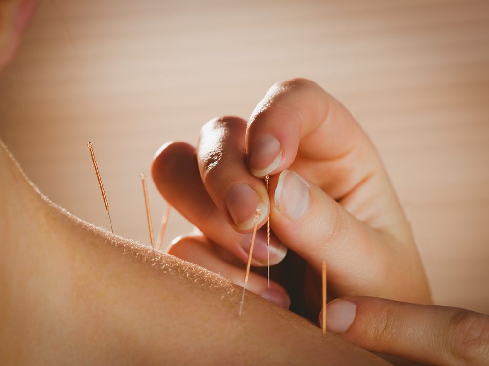 One of the best ways to quit smoking is acupuncture