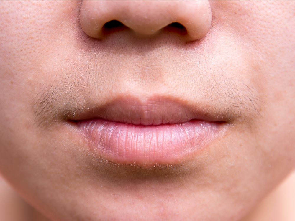 Excess facial hair could be a sign of disease