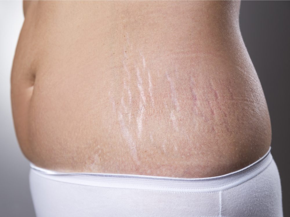 Dermatologists wish you would stop spending money on stretch mark creams