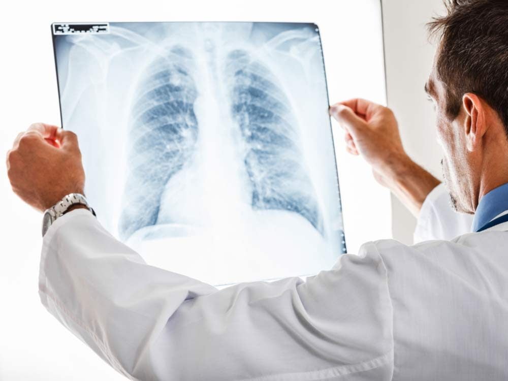 Doctor looking at lung x-rays