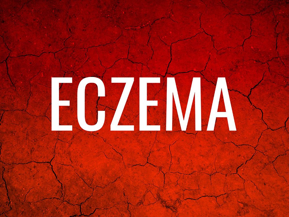 Skin condition: Eczema