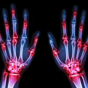 Types of arthritis: Rheumatoid arthritis