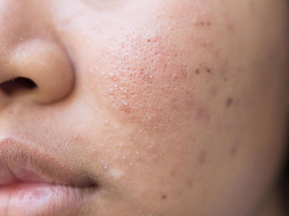 Acne on woman's face