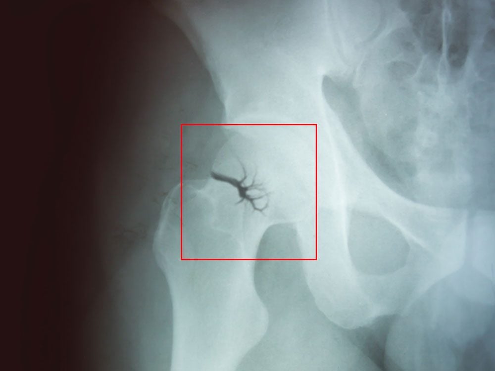 New health studies - broken hip x-ray