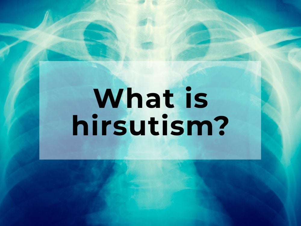 What is hirsutism?