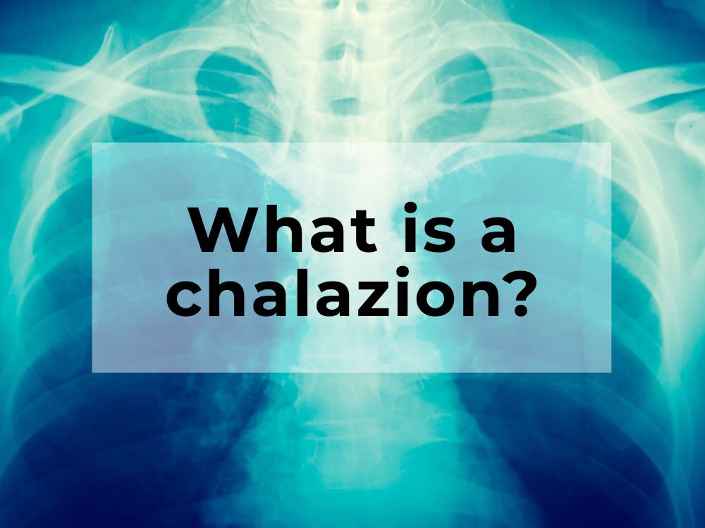 What is a chalazion?