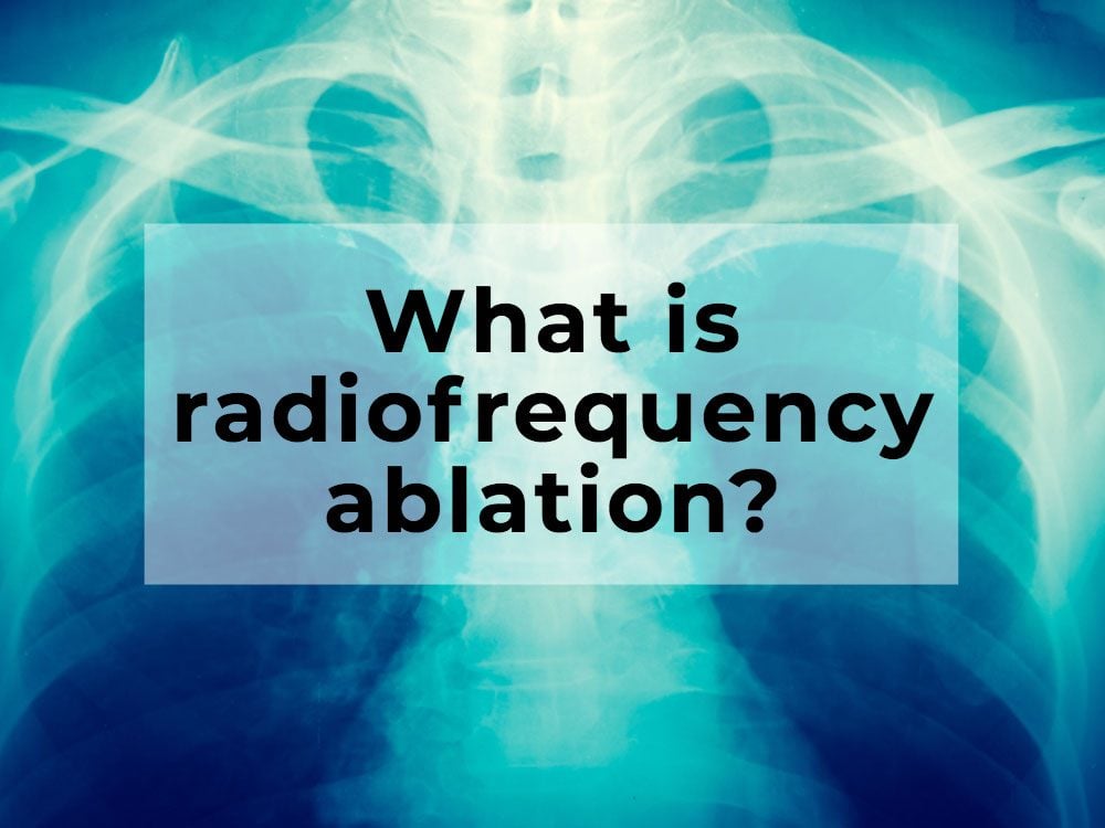 What is radiofrequency ablation?