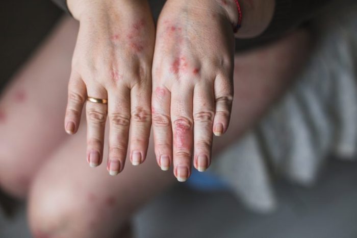 Psoriasis vulgaris on the womans hands with plaque, rash and patches on skin, isolated on white background. Autoimmune genetic disease. health concept