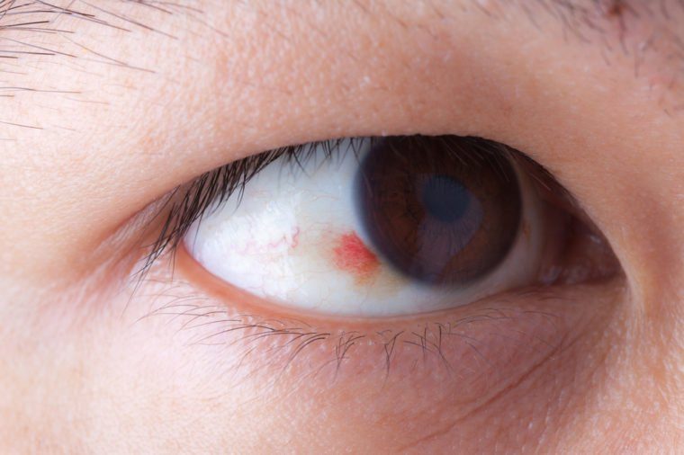 Close up of ubconjunctival hemorrhage in eye