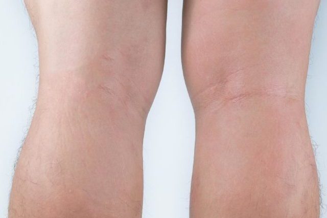 Allergic rash dermatitis eczema skin on leg of patient. Psoriasis and eczema skin with big red spots.