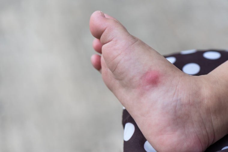 Allergic rash skin of baby's right foot with copy space.