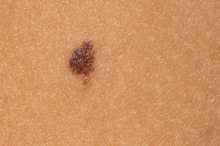 Macro of mole in the skin