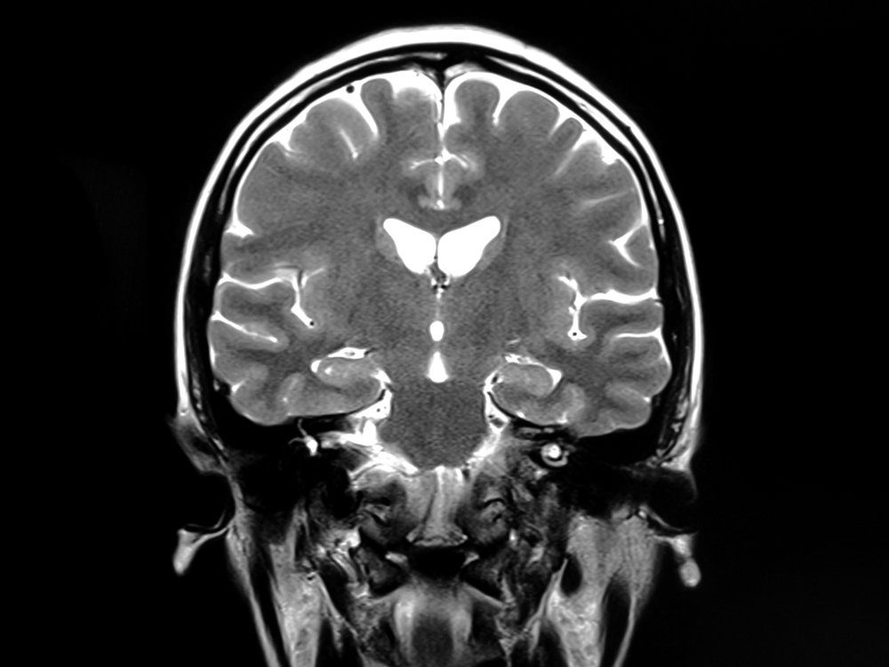 MRI scan of human brain