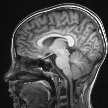 Magnetic resonance image (MRI) of the brain (sagittal view)
