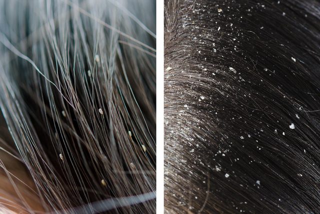Difference between lice and dandruff