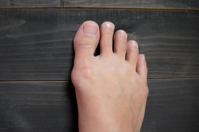 foot bunion