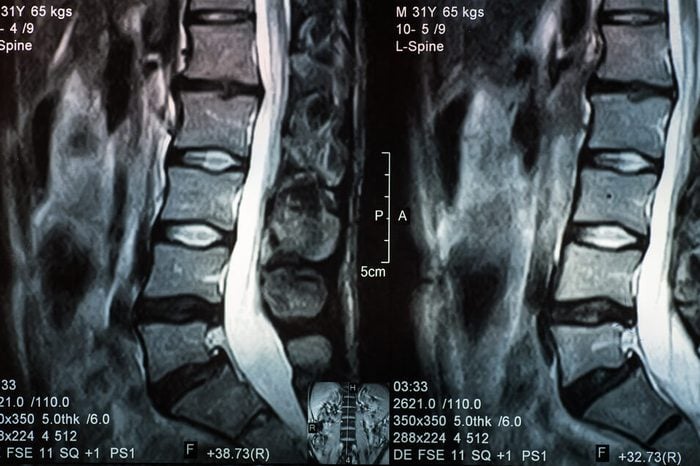 Magnetic resonance image of human spine with lordosis, disc herniation and spondylolisthesis l5-s1