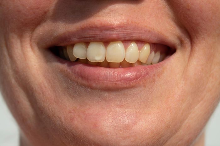 teeth spots