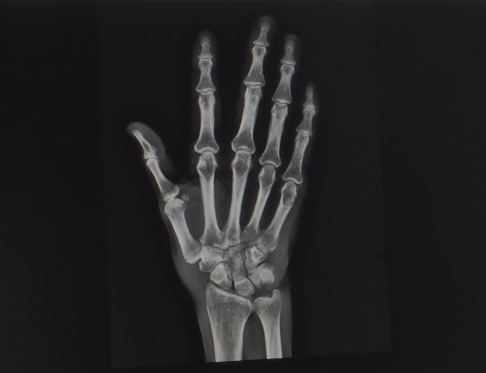 anteroposterior radiograph of a hand showing normal bones and joints. no sign of inflammation, arthritis or de quervain.
