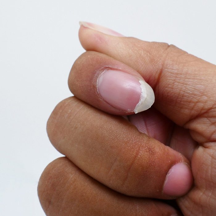 Fix a fingernail