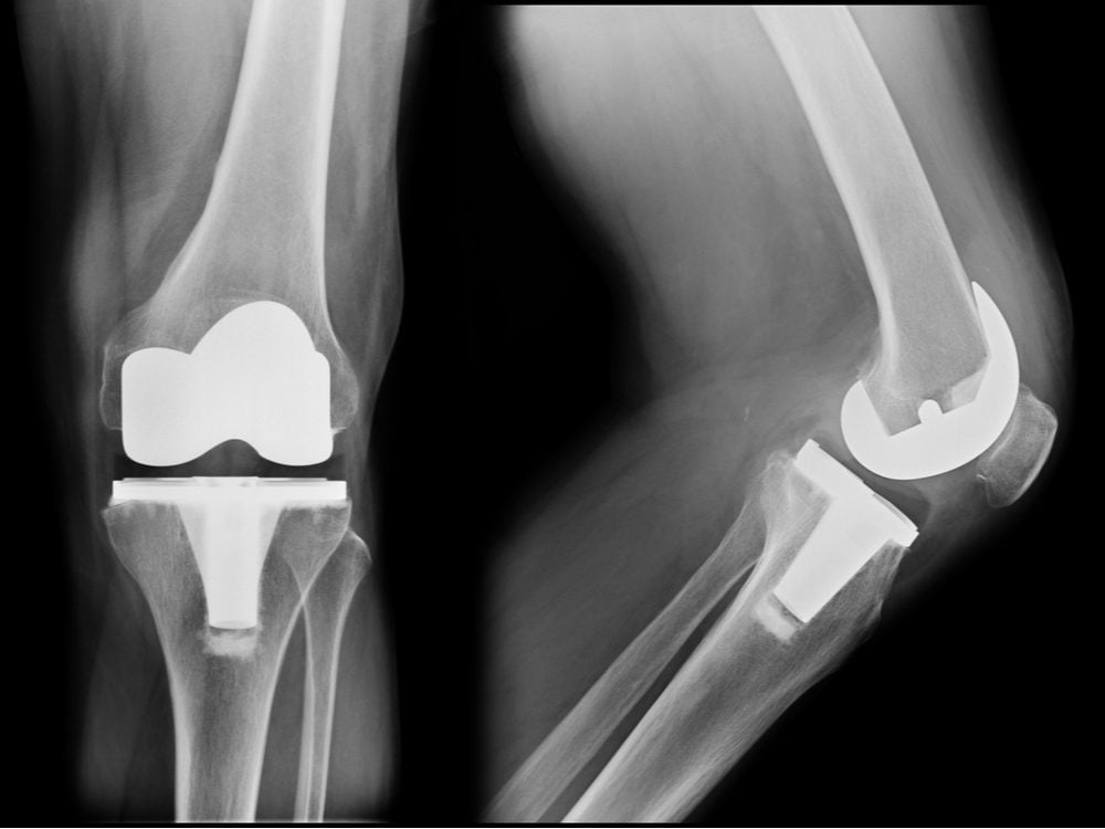 Knee replacement x-ray