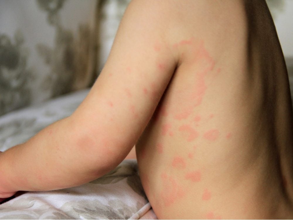 light allergy hives