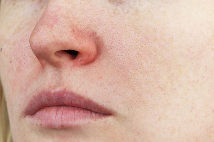 Cuperosis on the nose of a young woman. Acne on the face. Examination by a doctor
