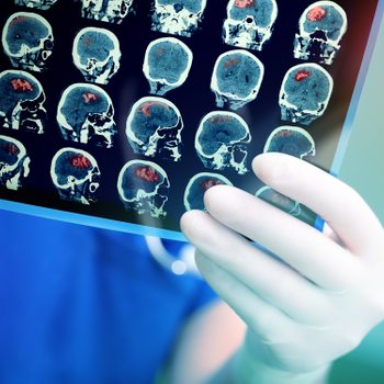 life after stroke brain scans
