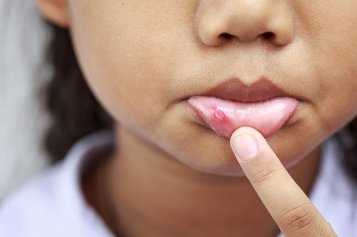 $1 solutions - Close up Children with aphtha on lip