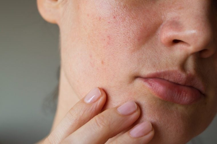 Pores on the skin of the face