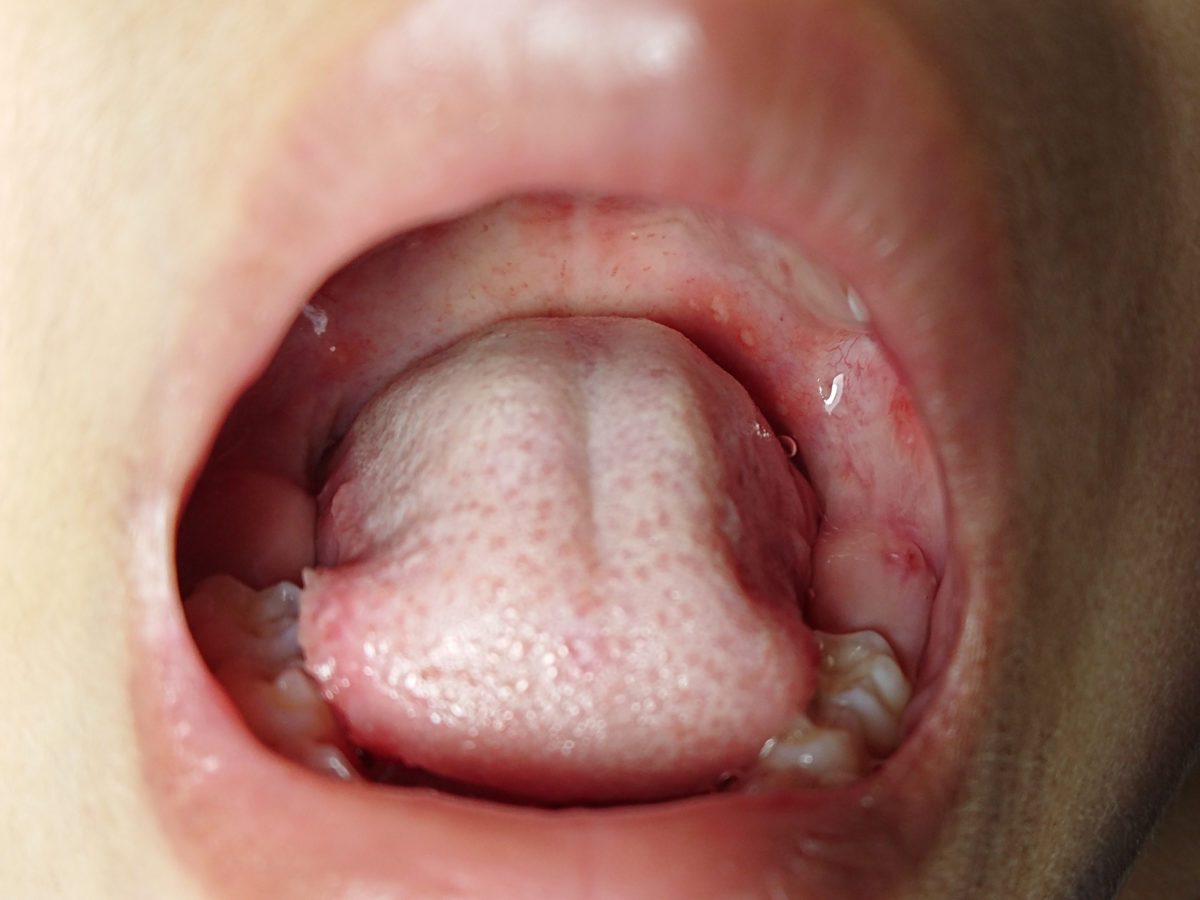 Painful sores on tongue