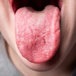 Wrinkles on tongue
