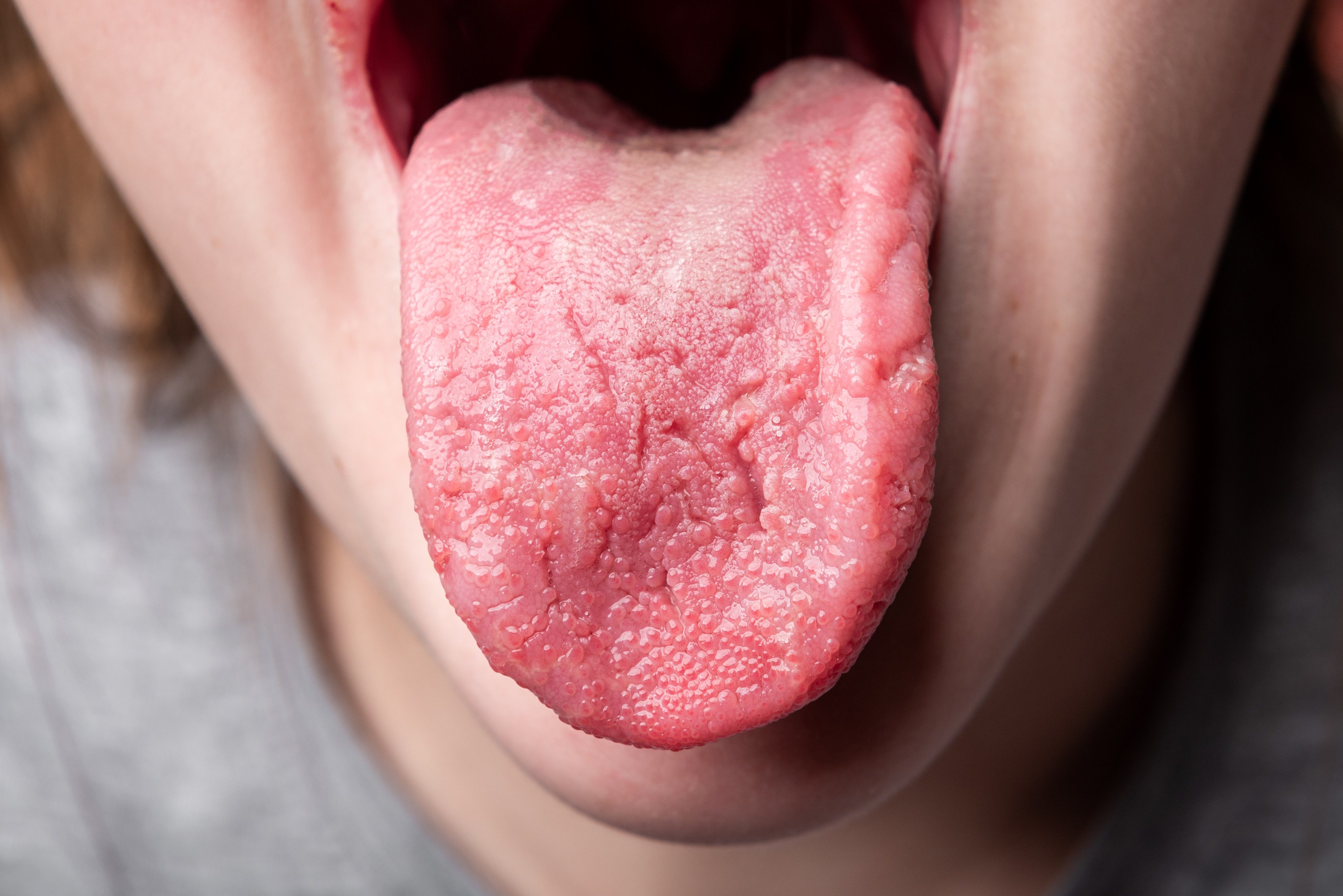 Wrinkles on tongue