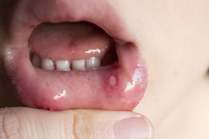closeup of a a mouth ulcer