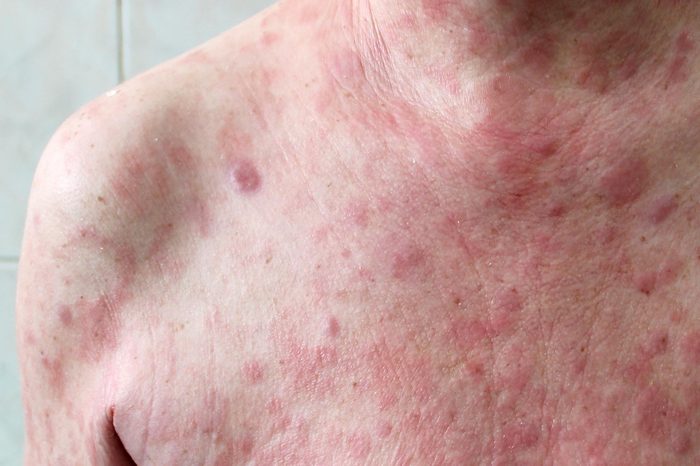 Rash closeup