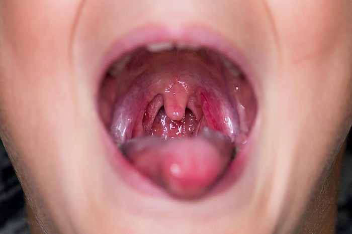 person with their mouth wide open, uvula visible
