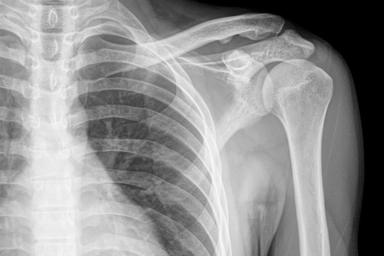 X-ray of shoulder blade