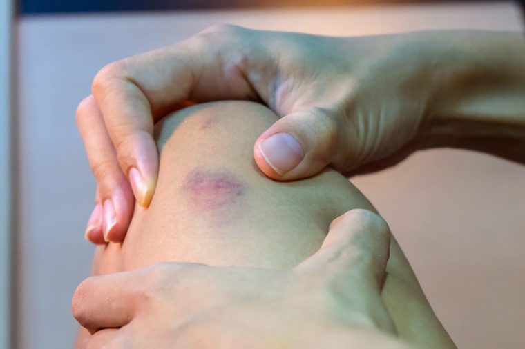 Bruise on woman's leg