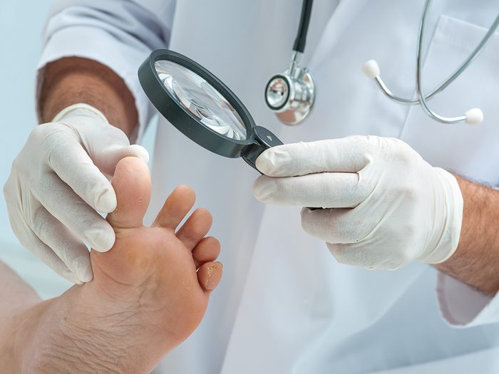 Foot symptoms - Doctor dermatologist examines the foot on the presence of athlete's foot