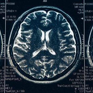 CSF leak - MRI of brain