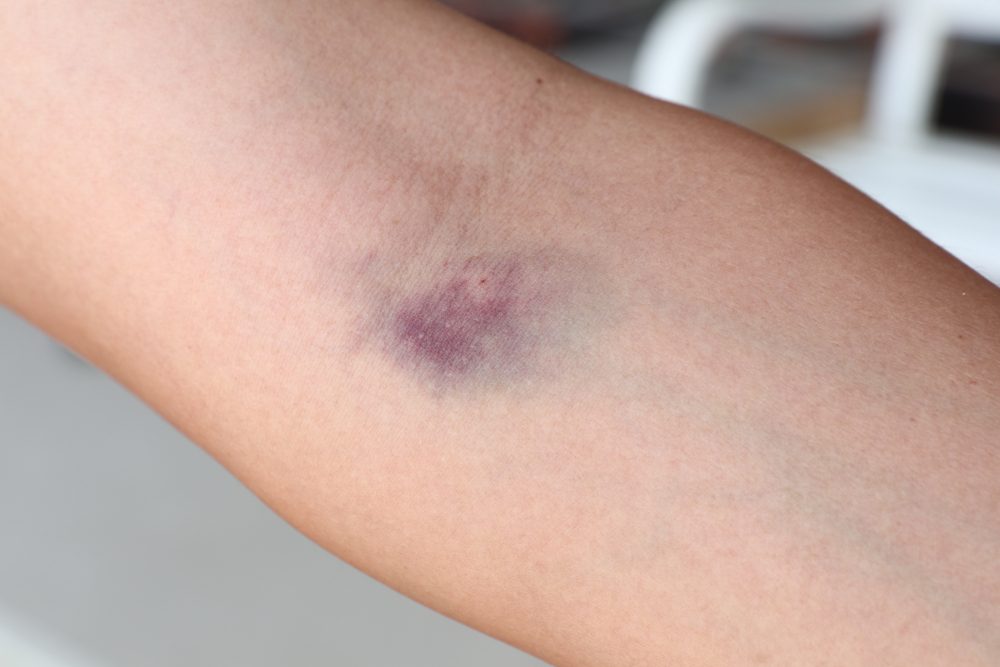Black Bruised elbow from injection blood test , needle