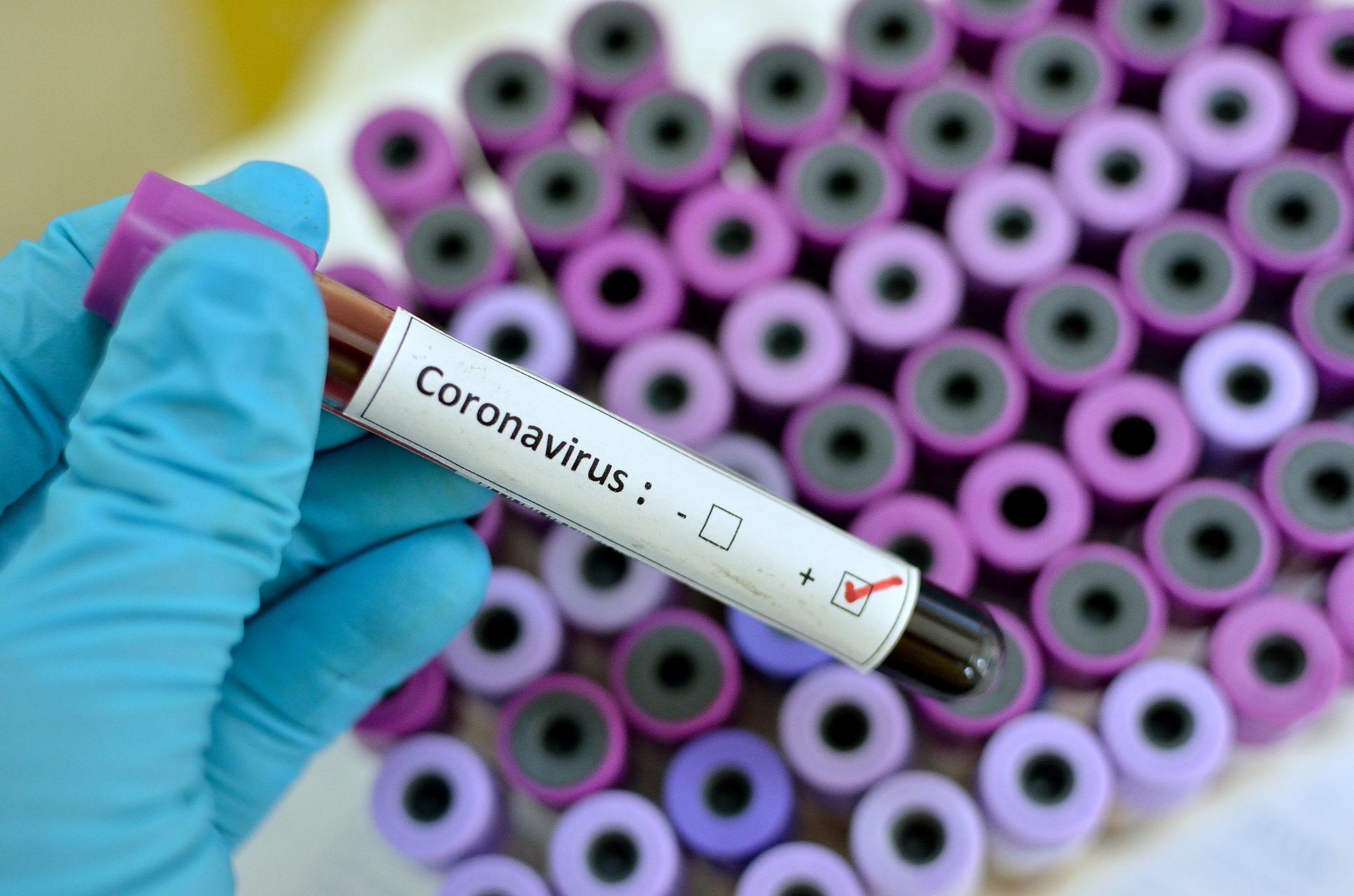 coronavirus blood sample diagnosis
