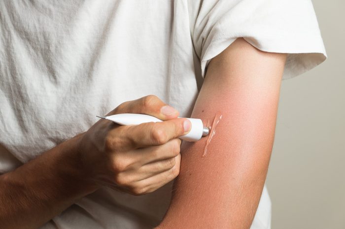 man applying gel to sunburn on arm cropped shot