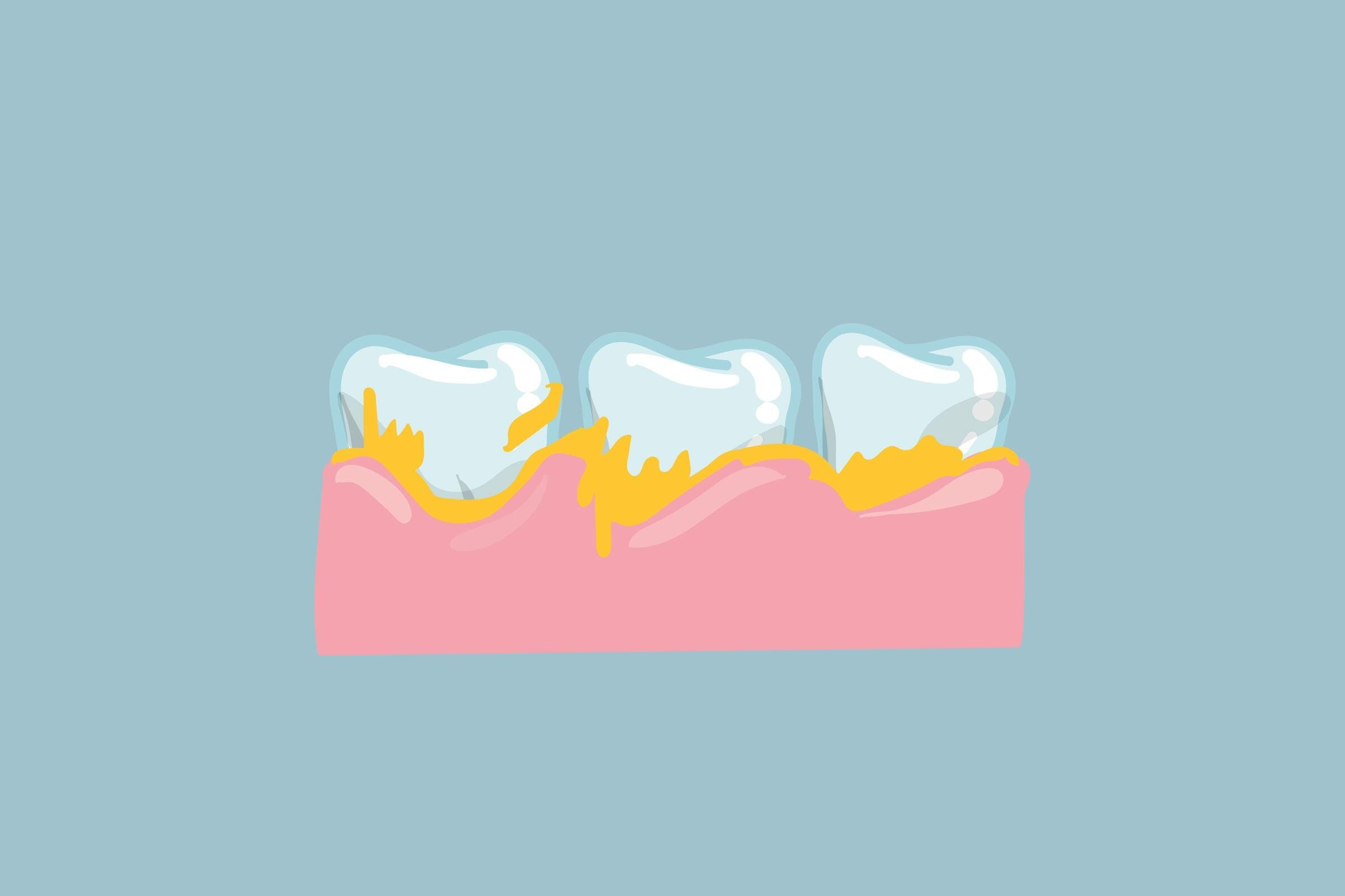teeth with plaque buildup