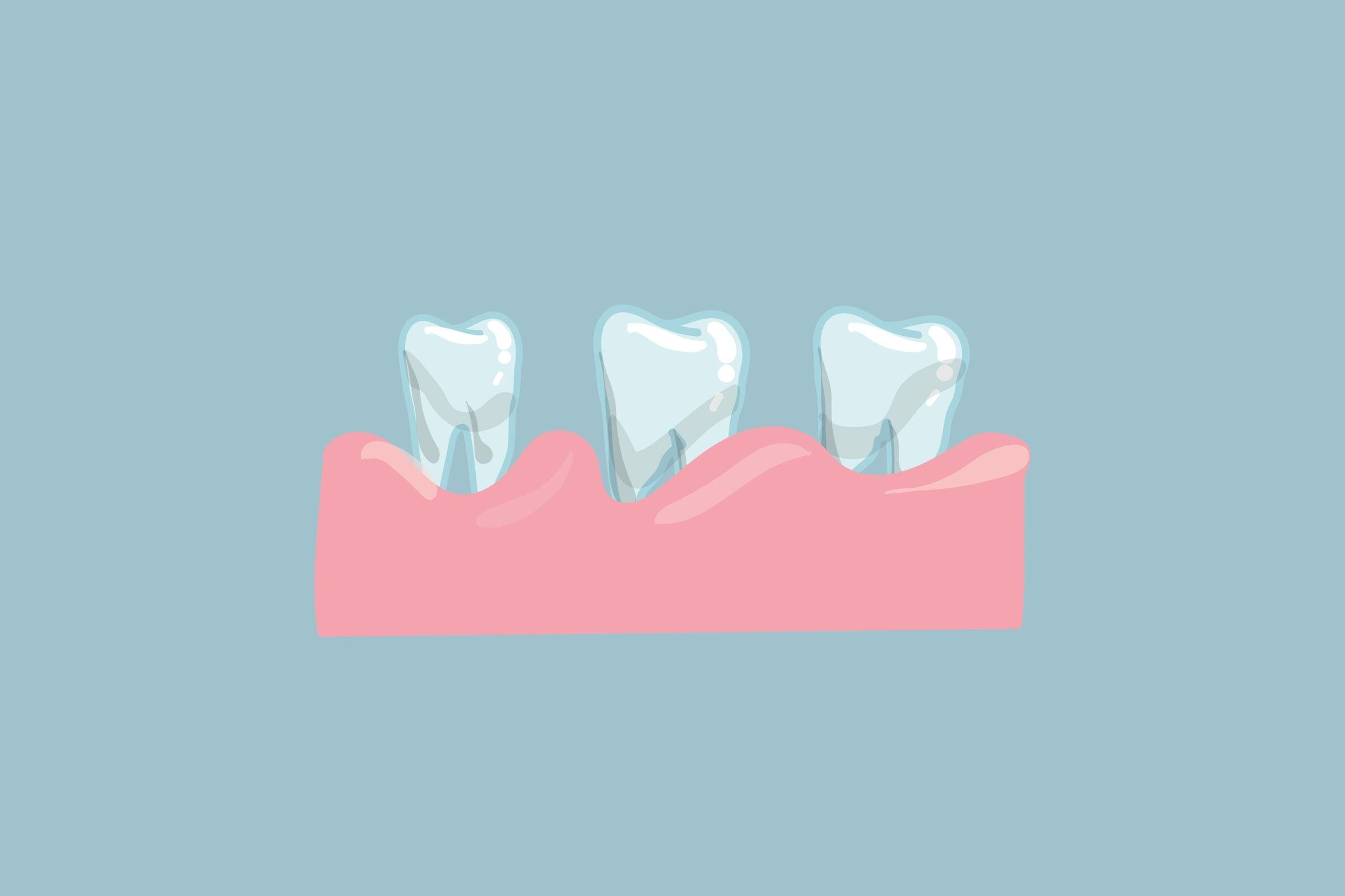 teeth bone loss